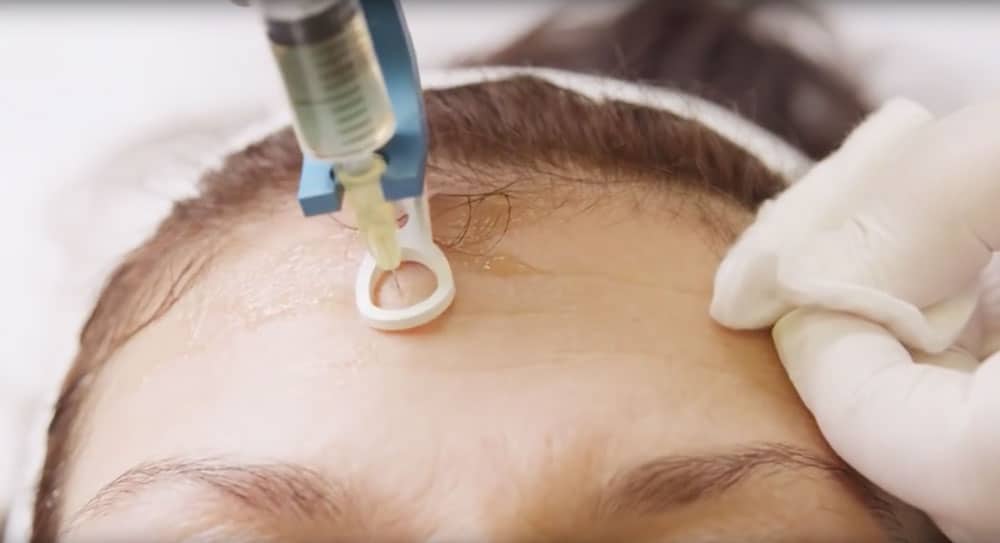 Mesotherapie Thumbnail - Mesotherapie