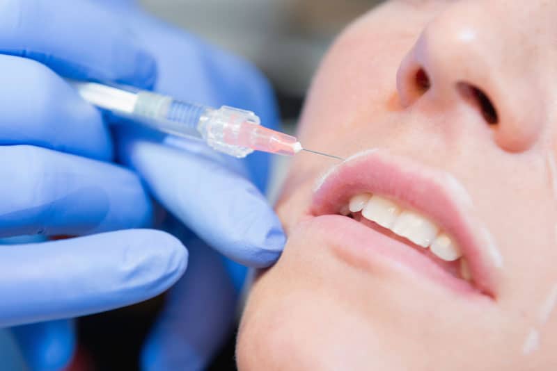 Mesolift und Faltenbehandlung Lippen aufspritzen - Mesolift und Faltenbehandlung