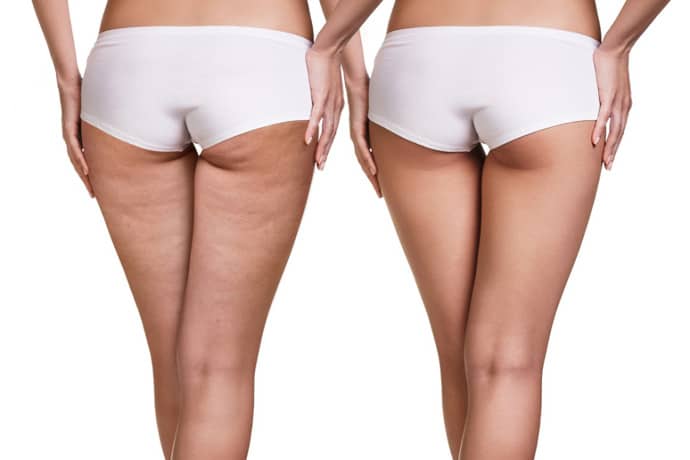 Ästhetik Cellulitetherapie mit Meso - Home